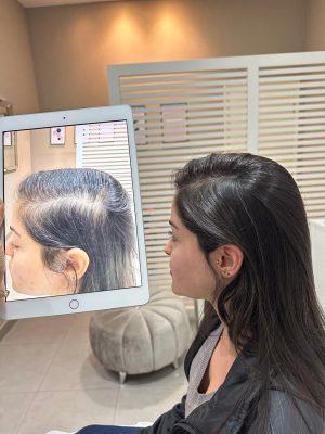 Queixas de quedas de cabelo crescem entre o público feminino depois da pandemia de Covid: minoxidil sublingual e ledterapia são alguns dos tratamentos. Crédito da foto: Divulgação.